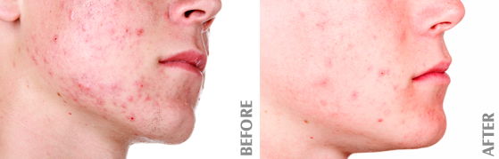 Acne Before and After